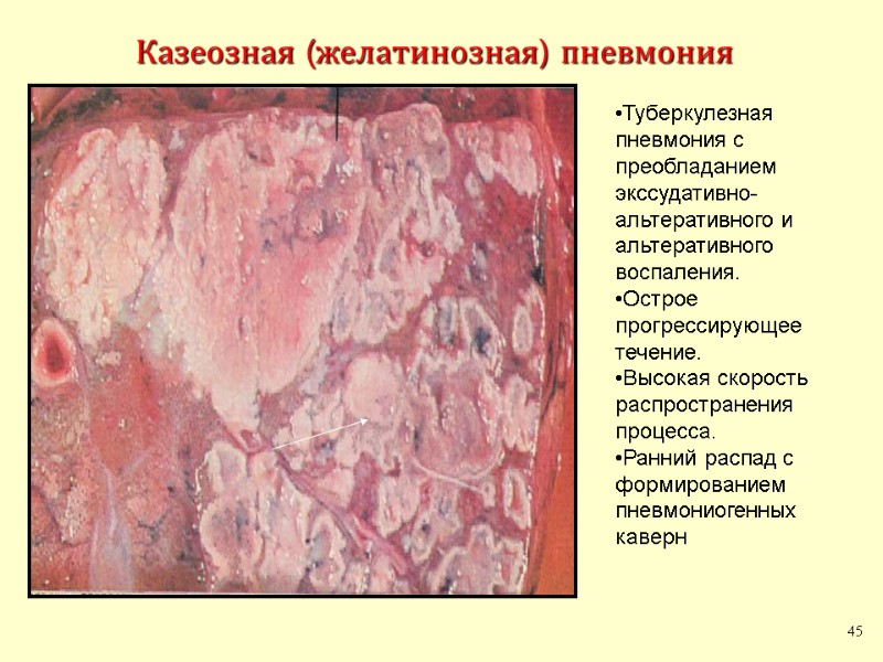 Казеозная (желатинозная) пневмония 45 Туберкулезная пневмония с преобладанием экссудативно-альтеративного и альтеративного воспаления. Острое прогрессирующее